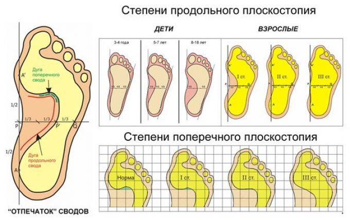 Степени продольного плоскостопия