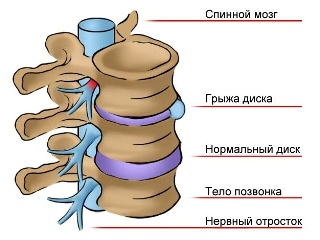 Болезни позвоночника: межпозвоночная грыжа