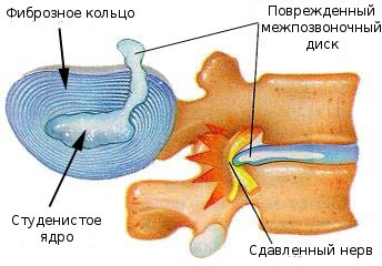 Болезни позвоночника: остеохондроз