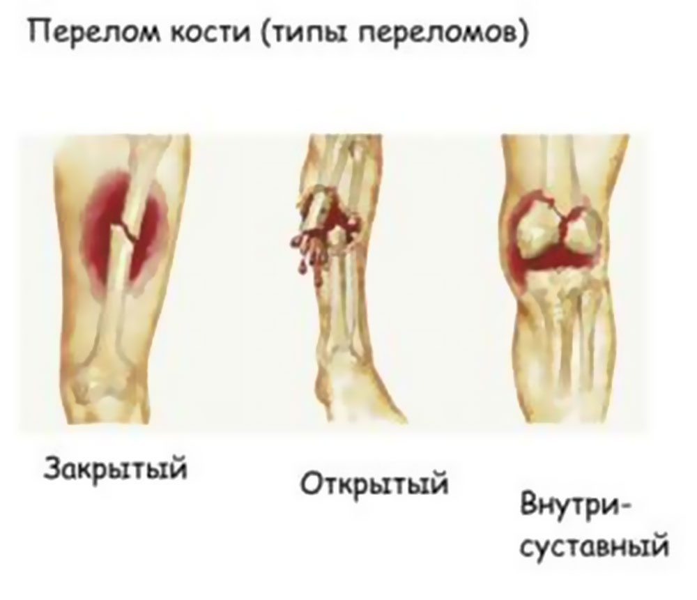 Перелом костей