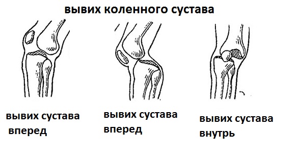 Вывих коленного сустава
