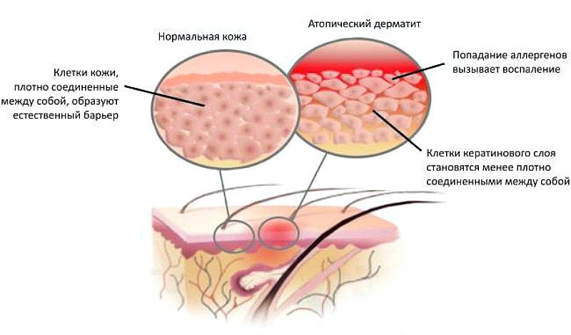 Аллергический дерматит у детей