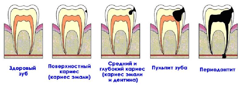 Болезни зубов: пульпит