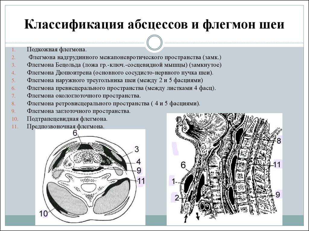 Классификация абсцессов и флегмон шеи