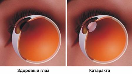 Катаракта