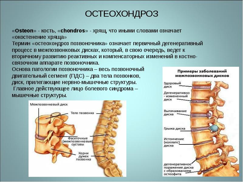 Остеохондроз. Что это?