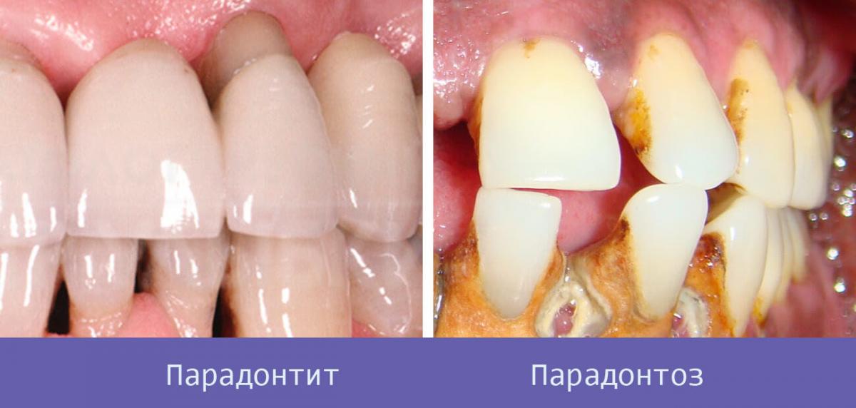 Парадонтоз и парадонтит