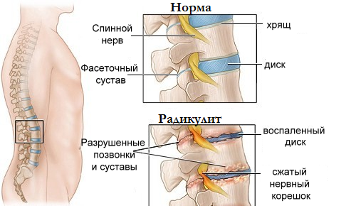 Причины появления радикулита. Смещение дисков и грыжа