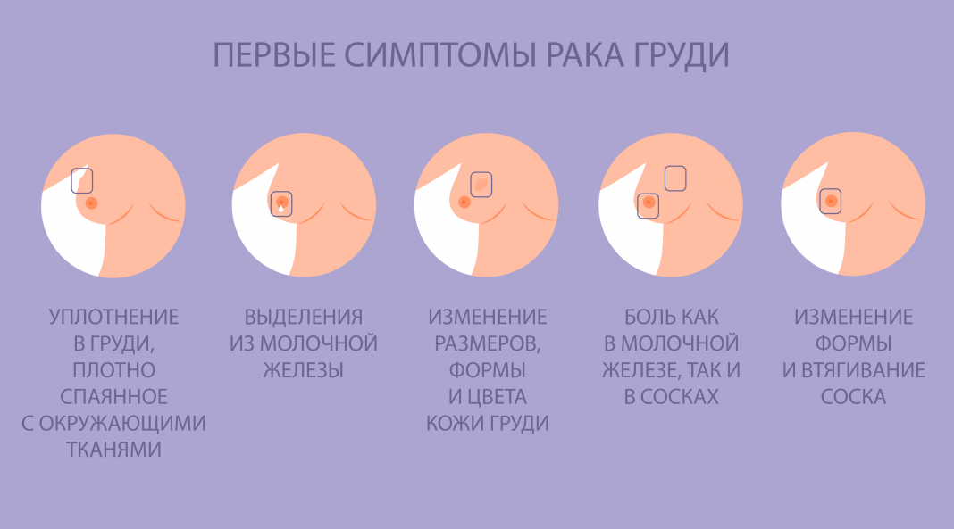 Методы лечения рака молочной железы