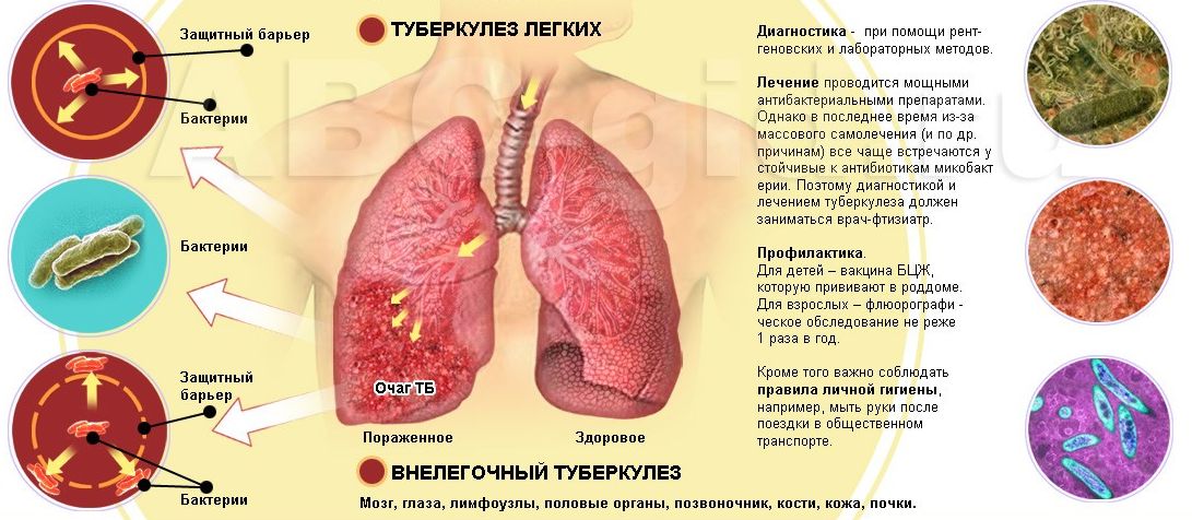 Туберкулез легких. Симптомы и причины болезни