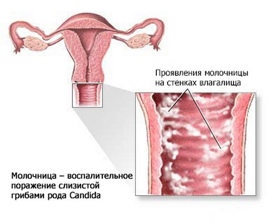 Молочница: симптомы и лечение заболевания