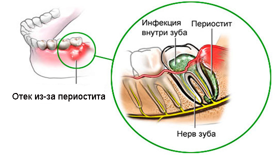 Болезни зубов: периостит